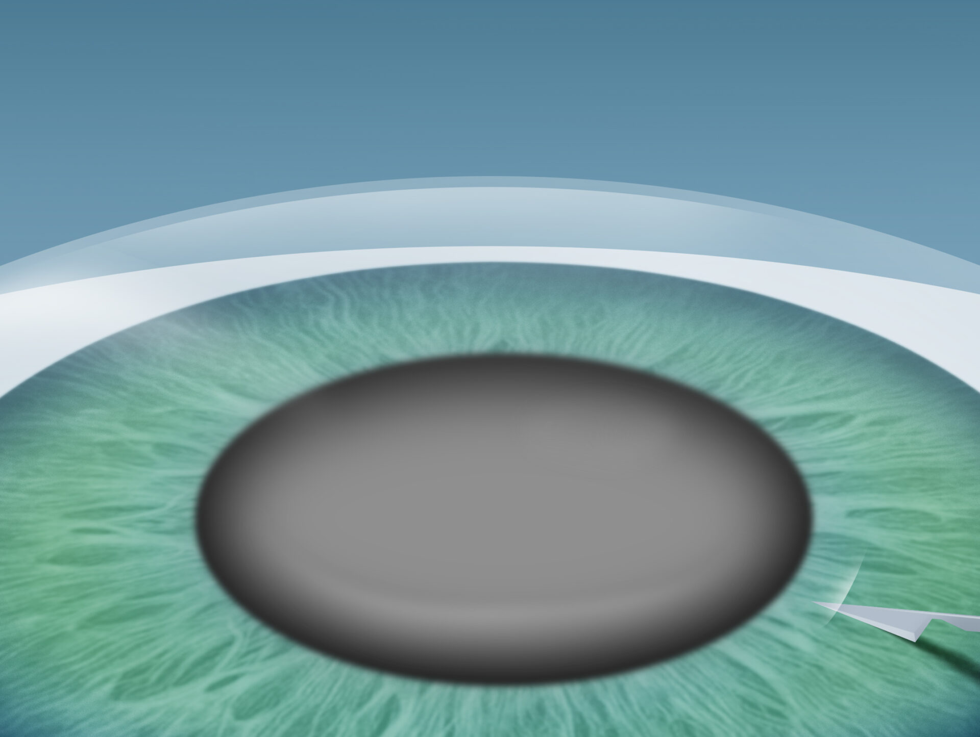 Grauer Star (Katarakt) Behandlung im Augenkompetenz Zentrum Cuxhaven