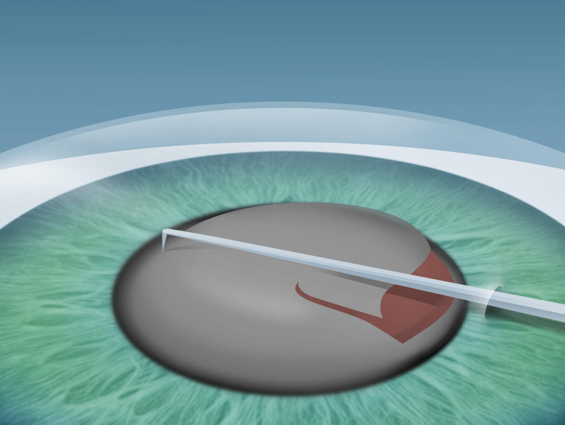 Grauer Star (Katarakt) Behandlung im Augenkompetenz Zentrum Cuxhaven