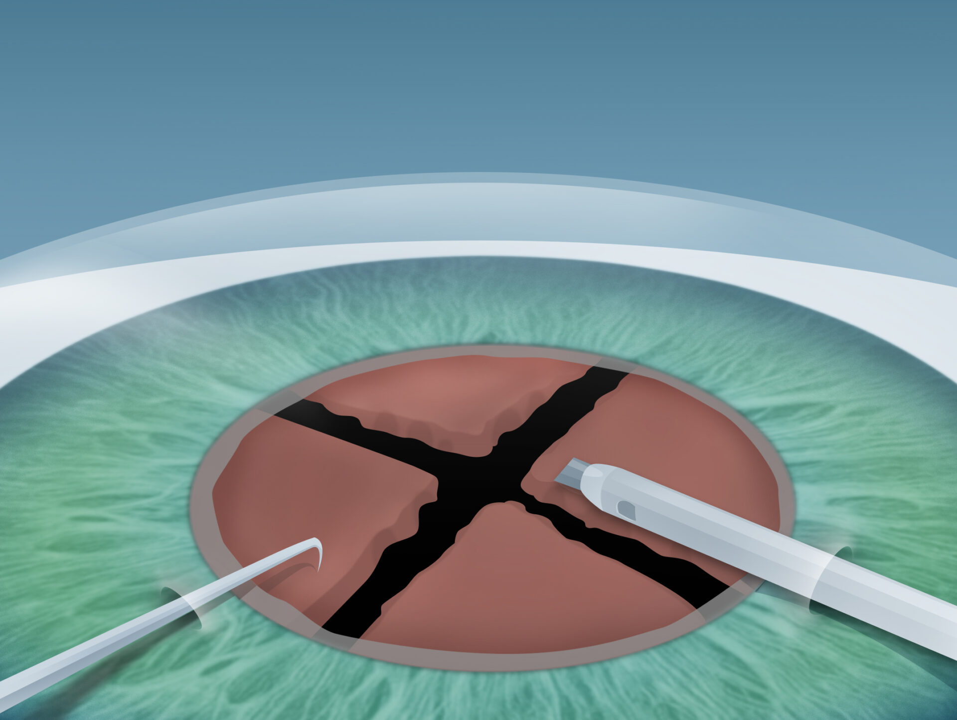 Grauer Star (Katarakt) Behandlung im Augenkompetenz Zentrum Cuxhaven