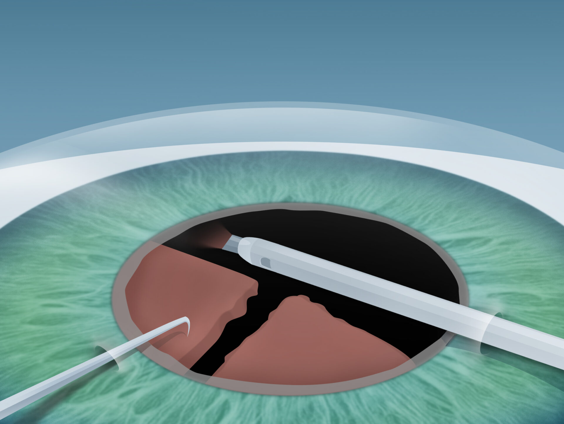 Grauer Star (Katarakt) Behandlung im Augenkompetenz Zentrum Cuxhaven