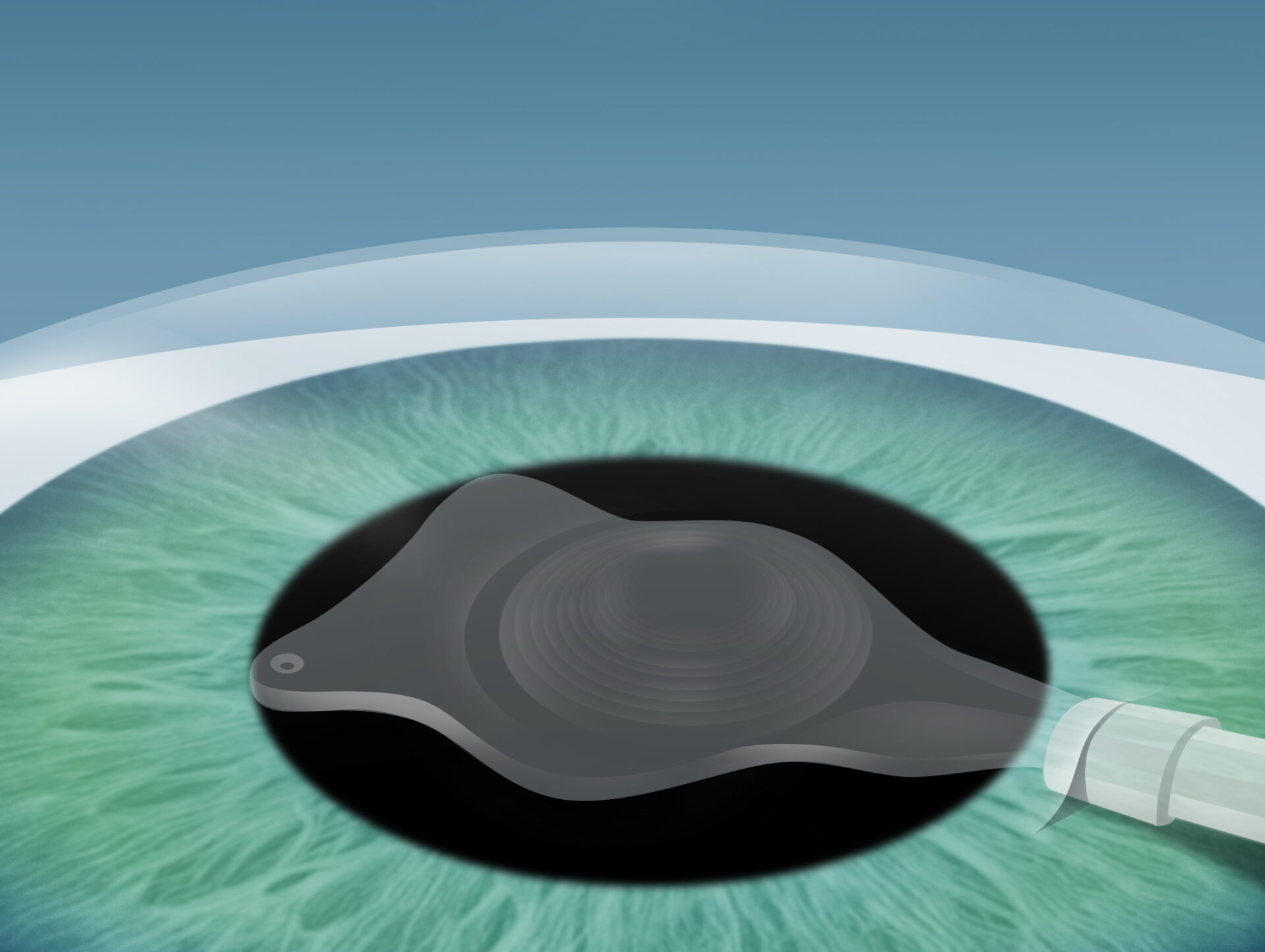 Grauer Star (Katarakt) Behandlung im Augenkompetenz Zentrum Cuxhaven