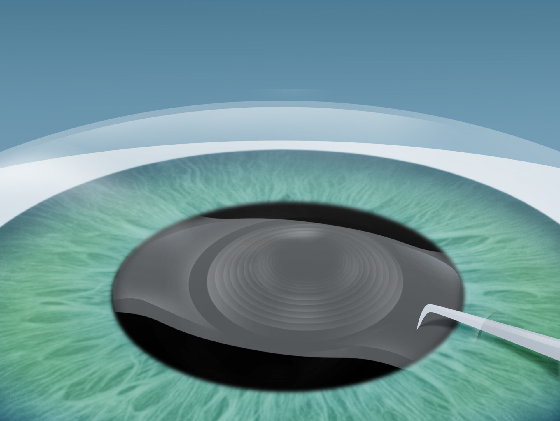 Grauer Star (Katarakt) Behandlung im Augenkompetenz Zentrum Cuxhaven